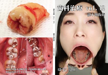 歯科治療　Vol.42