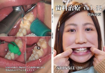 歯科治療　Vol.32