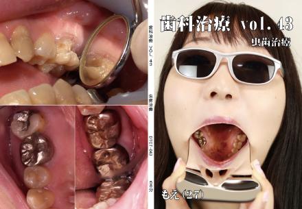 歯科治療　Vol.43