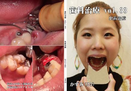 歯科治療　Vol.33