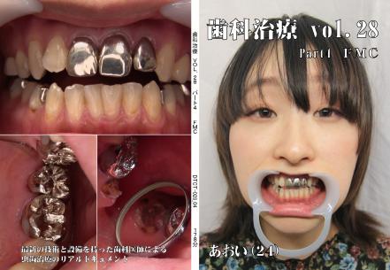 歯科治療 vol.28 part4