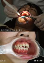 歯科治療⑥　ゆうみ
