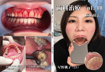 歯科治療　Vol,10