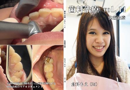 歯科治療　Vol,14